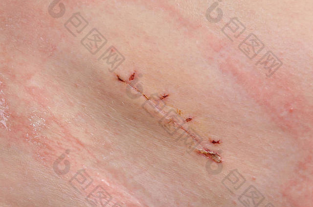 特写镜头新鲜的附录手术疤痕阑尾切除术