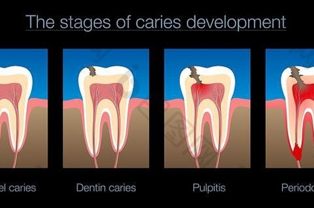 牙衰变阶段龋齿发展搪瓷牙质龋齿牙髓炎牙周炎插图黑色的背景