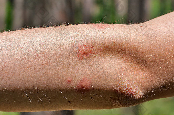 人体肘部蚊子叮咬痕迹特写