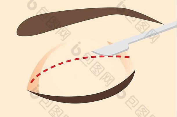 沿着设计的切口线在眼睑上使用刀。