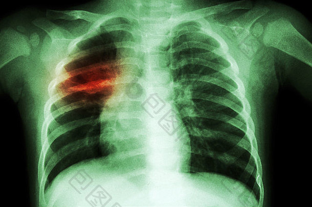 肺结核（儿童胸部X线：右中肺片状浸润）