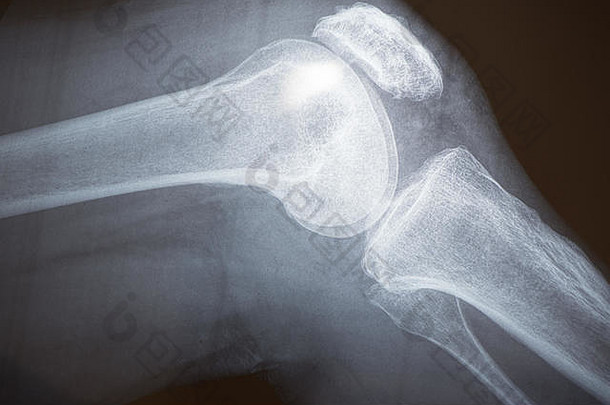 x光图像膝盖骨头