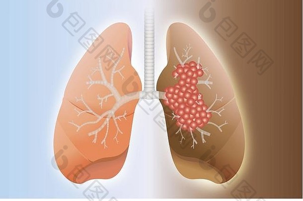 健康肺与癌肺的比较。