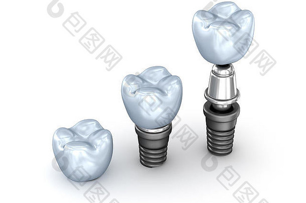 白色背景3D插图上隔离的牙齿植入物