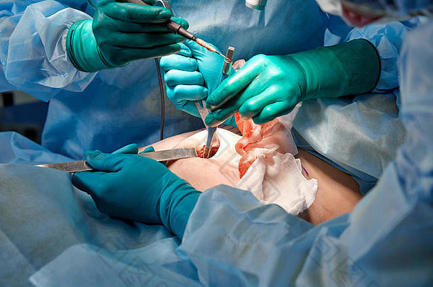 外科医生和他的助手在医院手术室对鼻子进行整容手术。鼻子整形，隆鼻。鼻整形术。