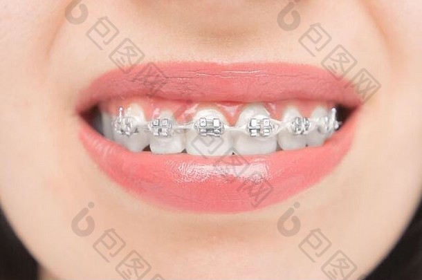 关闭牙科牙套括号牙齿美白self-ligating括号金属关系灰色的松紧带橡胶乐队