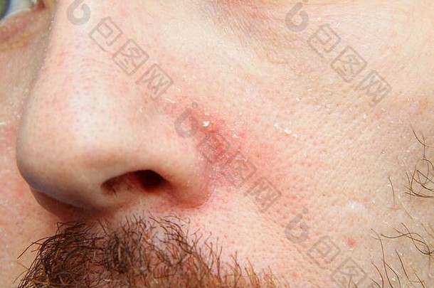 面部的一部分，有一个<strong>皮肤干燥</strong>、片状的成年白人的鼻子。<strong>皮肤</strong>问题和疾病。