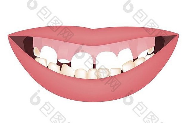 在进行矫正术或矫正术治疗前，孩子们的嘴下颌过大，笑线过高，或者笑得像胶一样。牙根下咬合