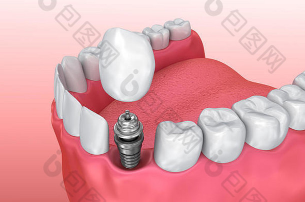 牙种植体过程，医学上精确的3D插图白色样式