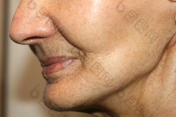 鼻唇沟皱纹。颈部面部皮肤上的皱纹。松弛的脸颊和脖子