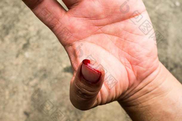 左拇指血流引起的估计谨慎的修复管道