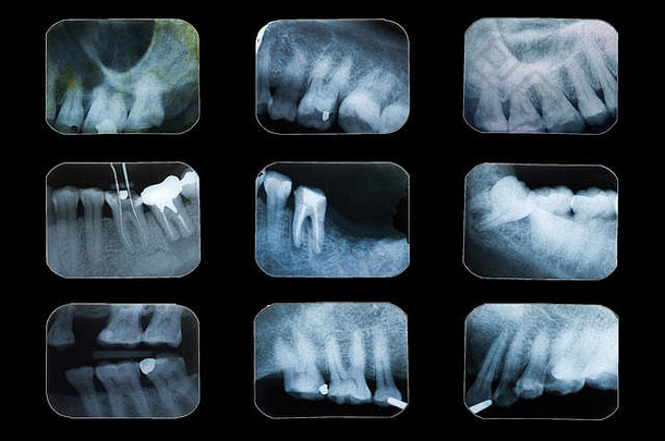 检查牙齿，黑色背景上的多齿x光片。