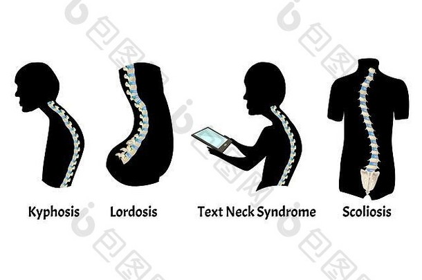 脊柱前凸、后凸的位置。文本颈部综合征。脊柱弯曲、脊柱后凸、脊柱前凸、脊柱侧凸、关节病。姿势和姿势不好