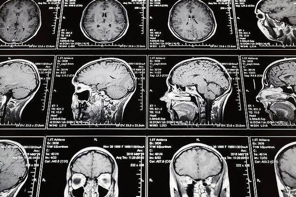 脑部磁共振扫描。核磁共振头部扫描。