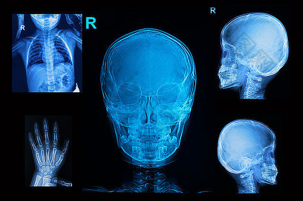 收集儿童x光图像显示头骨、胸部和手部图像