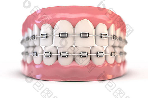 一对上下两组完美的人类牙齿，在一个孤立的背景上了钢制牙套-3D渲染