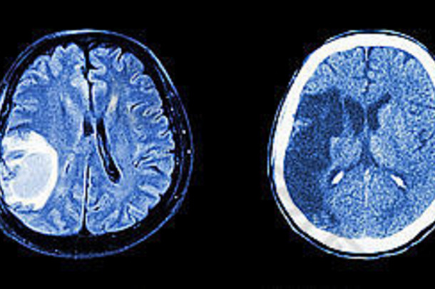 集合扫描大脑多个疾病左正常的大脑大脑肿瘤脑梗死大脑内的