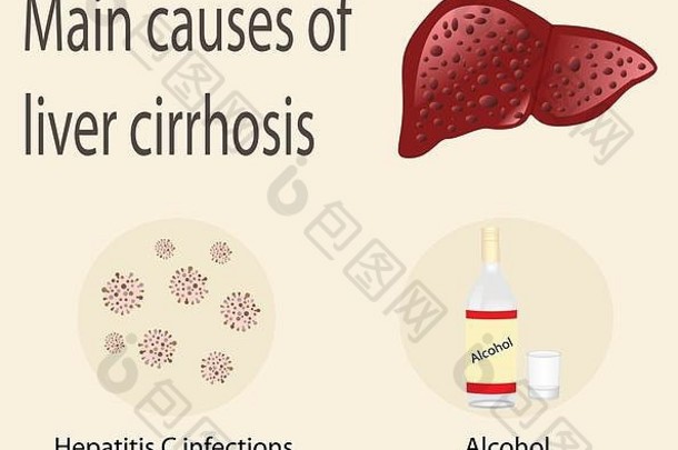 肝硬化丙型肝炎感染的主要原因和酒精载体插图信息图