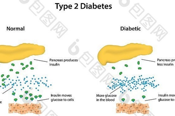 2型糖尿病