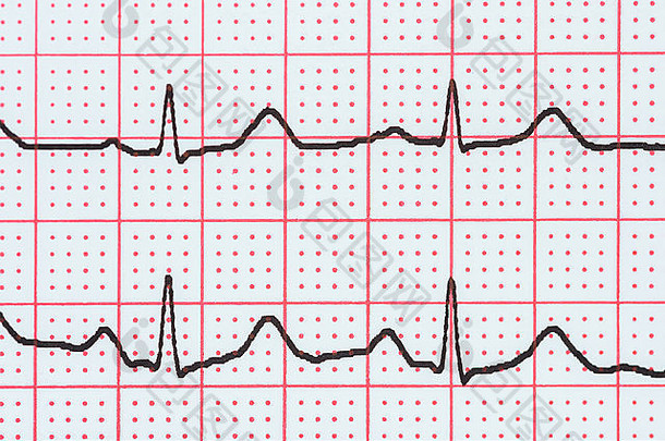 窦心节奏心电图记录纸显示正常的波时间间隔qrs复杂的