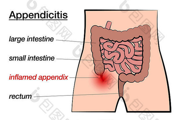 阑尾炎。阑尾发炎。白色背景上标有大肠、小肠、阑尾和直肠的图表。
