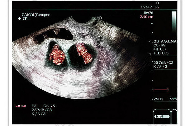 一名怀有双胞胎的孕妇的超声波检查