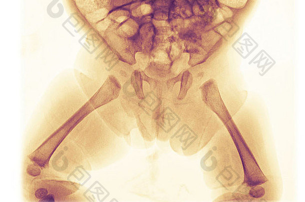 骨盆x光片显示骨骼发育