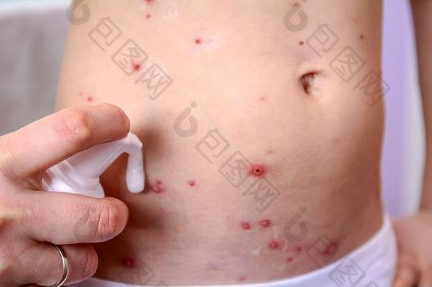 孩子皮肤受感染的水痘治疗防腐剂泡沫