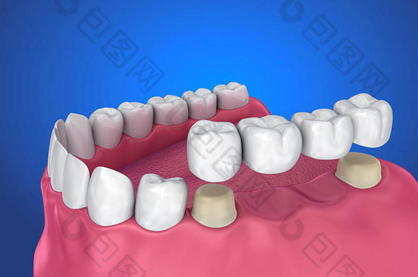 牙支持固定桥医学上准确的插图