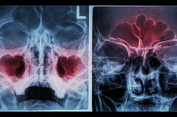 电影x射线鼻侧的窦显示鼻窦炎上颌骨窦左图像额窦图像