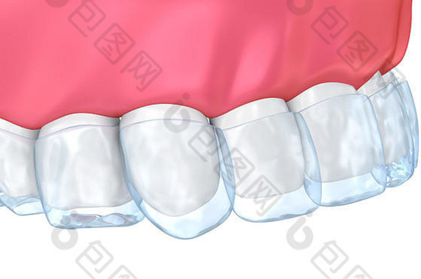 牙齿美白过程医学上准确的牙插图