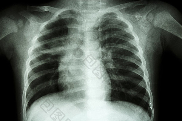 肺肺结核胸部x射线孩子显示不完整的渗透中间肺
