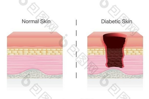 比较区别正常的皮肤糖尿病皮肤条件
