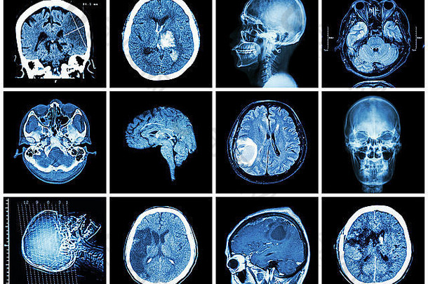 集合大脑疾病扫描核磁共振大脑显示脑梗塞大脑内的出血大脑肿瘤基底