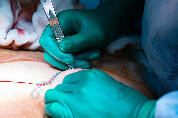 外科手术操作腹壁整形术外科手术删除<strong>脂</strong>肪组织腹部