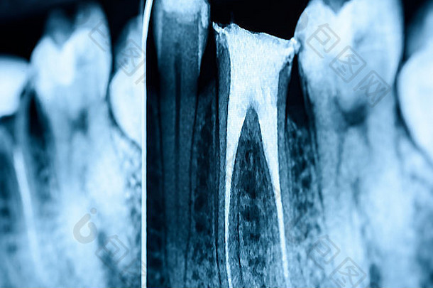 完整的密闭根运河系统牙齿x射线