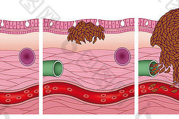 阶段进化黑素瘤皮肤