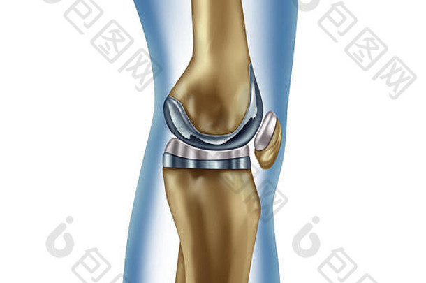 更换膝盖植入物医疗概念人类腿解剖学假体手术肌肉<strong>骨骼</strong>疾病治疗象征