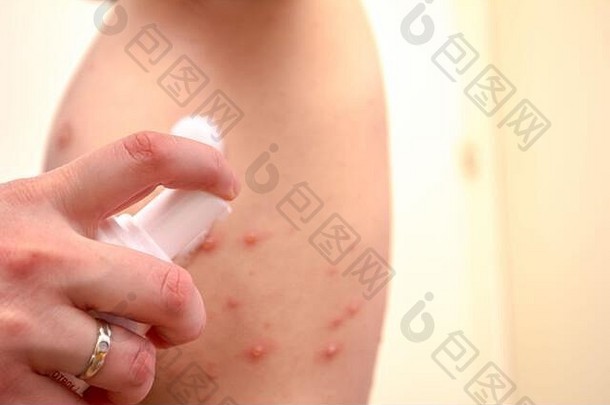 孩子皮肤受感染的水痘治疗防腐剂泡沫