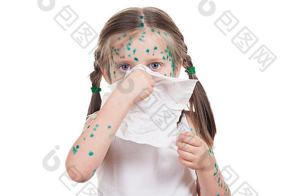 acnes孩子水痘