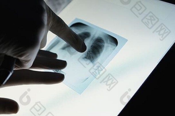 医生检查胸部x射线男人。持有射线照相法脊髓列考试解剖学科学职业病人事故概念
