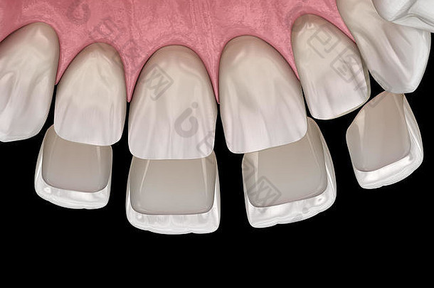 单板安装过程中央切牙横向切牙医学上准确的牙插图