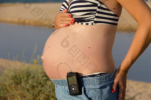 糖尿病怀孕了女人胰岛素泵海滩她是穿蓝色的裙子条纹比基尼前