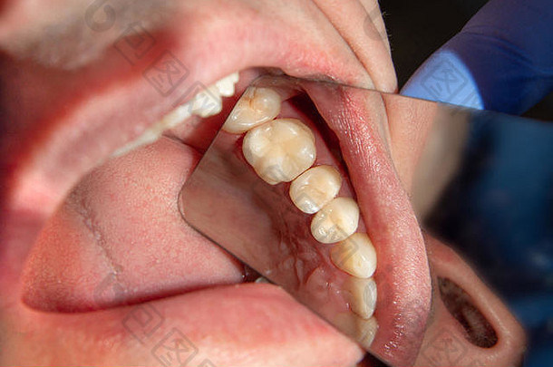 牙科治疗牙科诊所腐烂的腐烂的牙特写镜头宏治疗牙髓学的运河