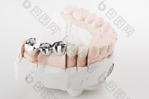 桥接牙科假体使钢陶瓷粘贴